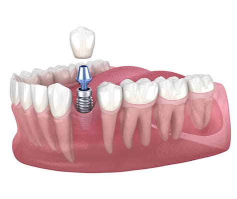 Single Tooth Implant