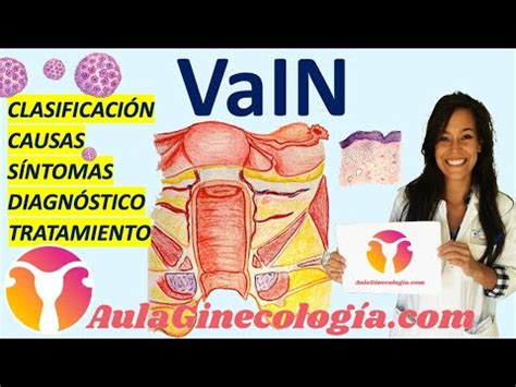 Vain Neoplasia Intraepitelial De Vagina Diagn Stico Y Manejo