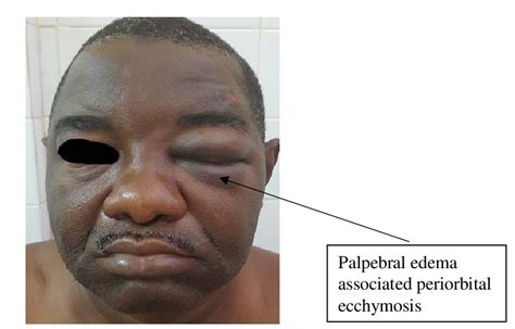 Palpebral edema associated with a left periorbital ecchymosis ...