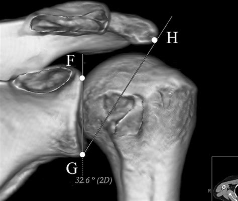 Critical Shoulder Angle Csa The Superior Most Point F And