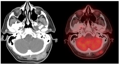 Axial Contrasted Computed Tomography Ct Of The Head On Left With