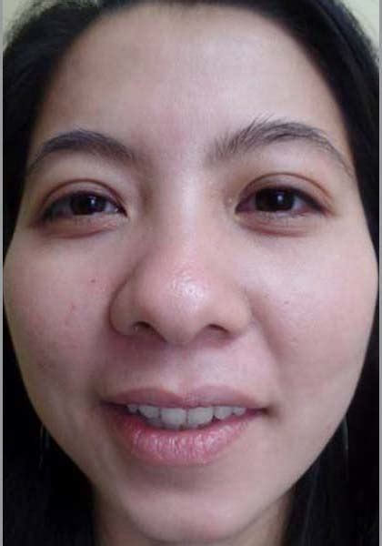 Before & After | Acne | Dr. Nguyen Health Center