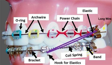 Parts Of Braces Ann Arbor Embrace Orthodontics