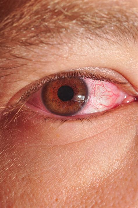 Pinkeye Conjunctivitis Harvard Health