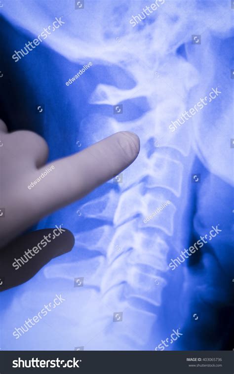 Vertebrae Xray: Over 4,232 Royalty-Free Licensable Stock Photos ... 