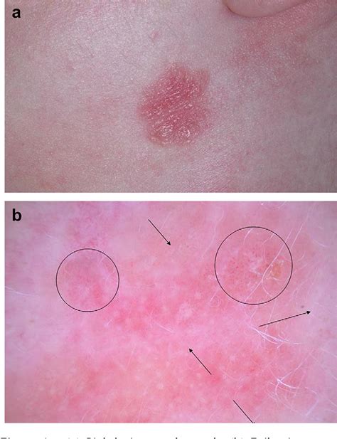 Amelanotic Melanoma Skin Cancer