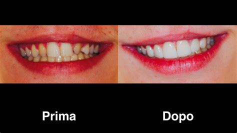 Faccette Dentali Migliora L Aspetto Estetico Del Tuo Sorriso