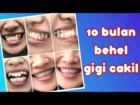 Bulan Perawatan Behel Gigi Cakil Menjadi Normal Gigi Cameh Dibehel