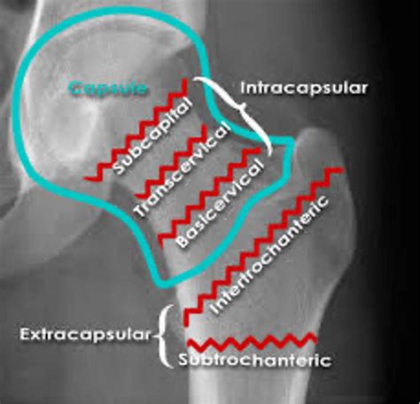 Intertrochanteric Fracture Vs Femoral Neck Fracture