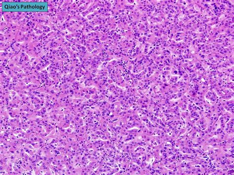 Qiao S Pathology Oncocytic Papillary Renal Cell Carcinoma A Photo On