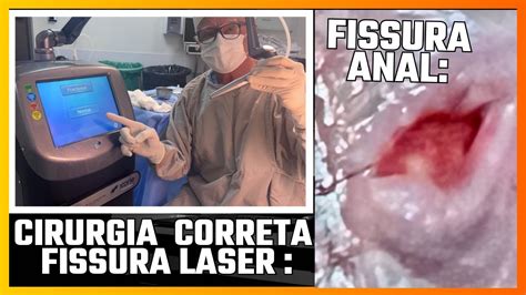 Proctologista fala cirurgia c laser correta fissura anal crônica anestesia local alta a seguir