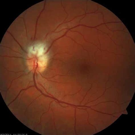 Regression of the optic nerve disc edema after decompres­ sion of optic ...