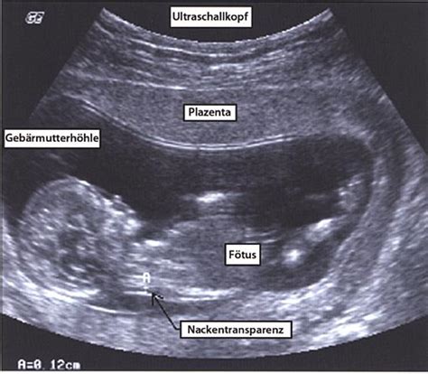 Down Syndrom Ultraschall Erkennbar Quotes Viral