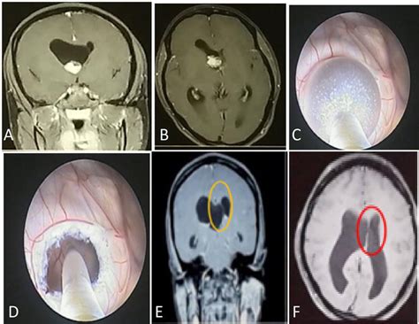 Lesions At The Foramen Of Monro Causing Obstructive Hydrocephalus Intechopen