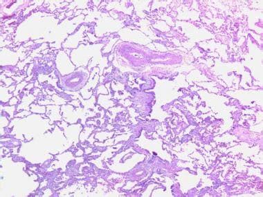 Interstitial Lung Disease Histology