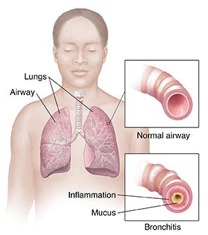 Acute Bronchitis University Hospitals