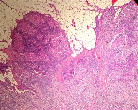 Medullary Like Carcinoma Of The Breast With Apocrine Morphology