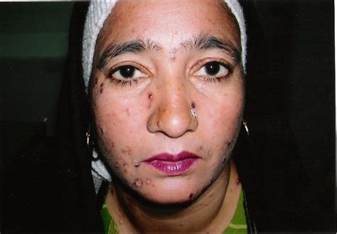 Eruptive Xanthomatosis Face