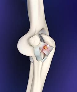 Elbow Ligament Injuries Columbia | Lateral Collateral Ligament Surgery ...