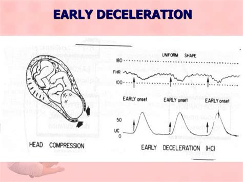 Ppt Lecture 10 Fetal Distress Powerpoint Presentation Free Download Id 9363834