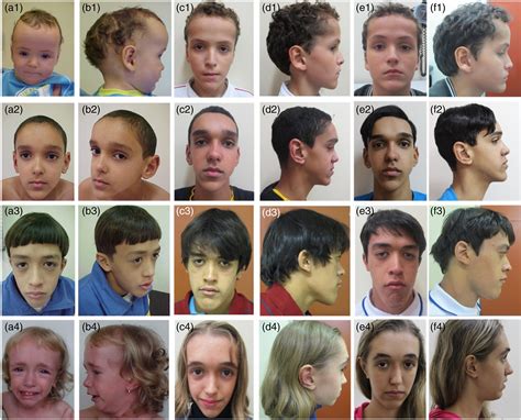 Twentyyear Followup Of The Facial Phenotype Of Brazilian Patients