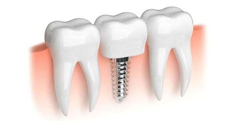 Conoces El Funcionamiento De Los Implantes Dentales Cortos