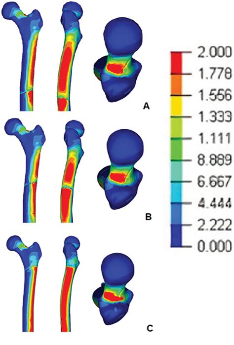 Figure 1 From Stability Of Proximal Femoral Osteotomies In Pediatric