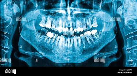 Radiografía dental panorámica de la mujer ortopantograma Imagen