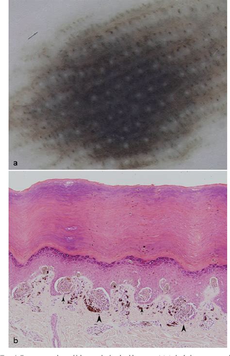 Figure From Dermoscopic Characteristics Of Acquired Melanocytic