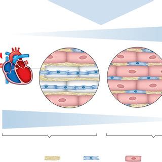 Myocardial Remodeling In Hfref And Hfpef Hfref Heart Failure With