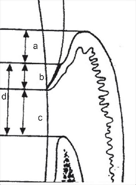 Biologic Width And Its Importance In Periodontal And Restorative Dentistry Pmc