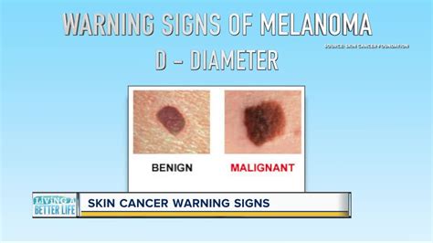 Most Common Spots For Skin Cancer Cancerwalls