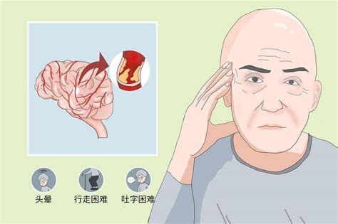 脑血管疾病秋季高发，这些知识你知道吗？ 贾栋副主任医师 爱问医生