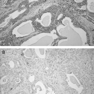 Immunohistochemical Stains A Diffuse Immunoreaction For Ck Ae Ae