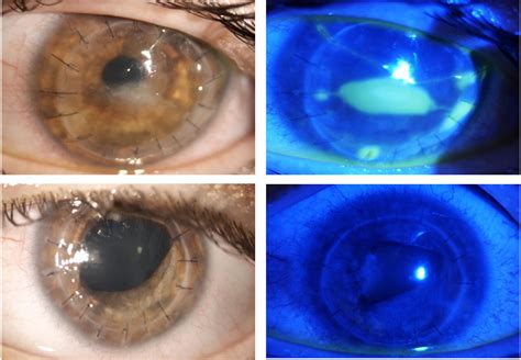 Figure 1 From Role Of Topical Cenegermin In Management Of A Cornea Transplant In A Functionally