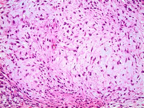 Pathology Outlines Teratoma