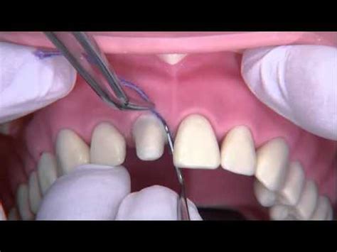 Gingival Retraction And Final Impression Youtube