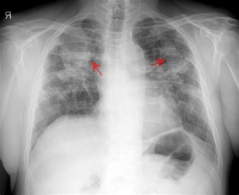 X-Ray Picture Of Sick Lung « zubumy48