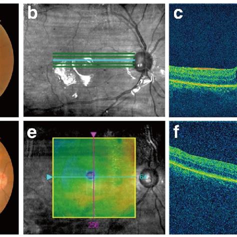 Multimodal Imaging Of The Affected Eye A Preoperative Fundus