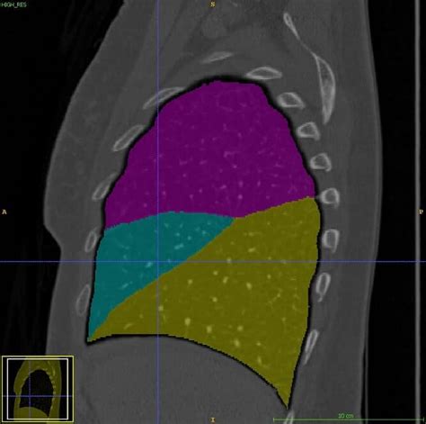 Lung lobes Segmentation in CT Scans by RSIP Vision