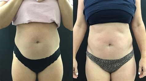 Emsculpt Neo Before And After Gallery Palm Beach Delray Port St Lucie