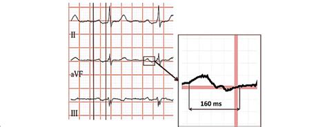 ECG example of prolonged P wave duration with biphasic (+/−)... | Download Scientific Diagram