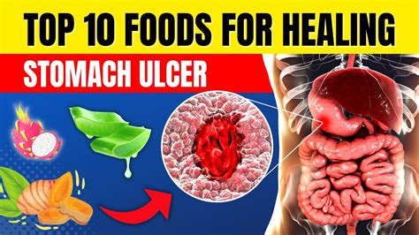 Top 10 Foods To Heal Your Stomach Ulcer Naturally Peptic Ulcer Health Tutor Youtube