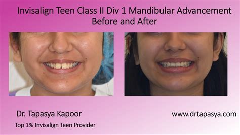 Invisalign Teen Treatment Class Ii Correction With Mandibular Advancement Youtube