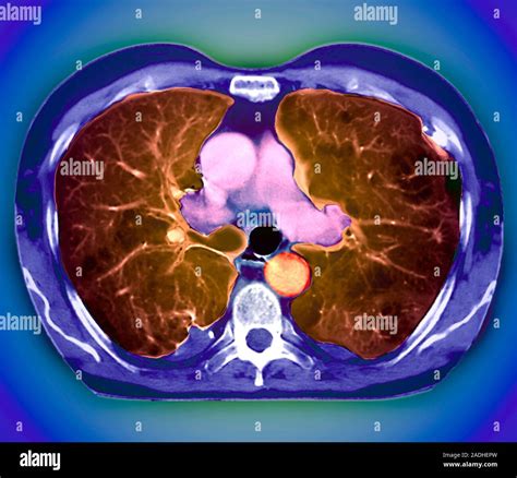 Emphysema. Coloured computed tomography (CT) scan of an axial section ...