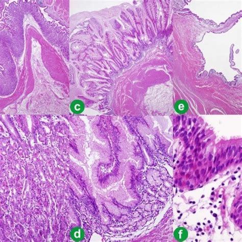 A Axial Ct Shows Cystic Tumor In The Pancreas Tail Cm Diameter