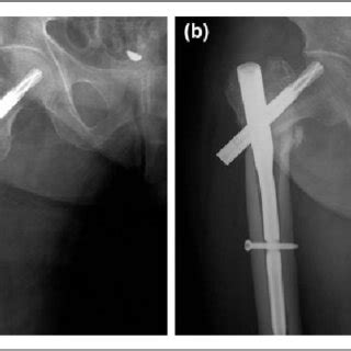 A Postoperative Ap Radiograph Shows That The Fracture Was Well