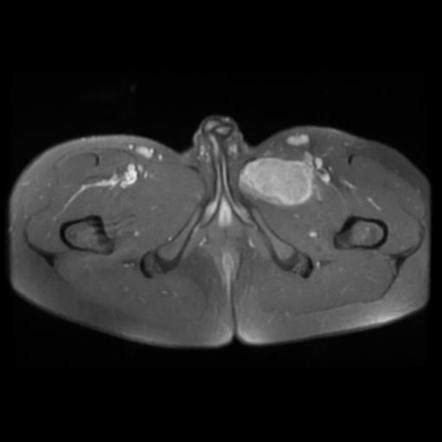 Alveolar soft part sarcoma | Radiology Case | Radiopaedia.org