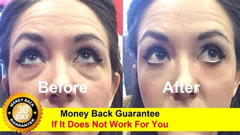 Eye Bags Treatment Non Surgical Eye Bags Treatment Youtube