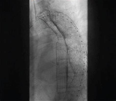 Imaging Showed Esophageal Stenting To Repair The Aortic Stent Download Scientific Diagram